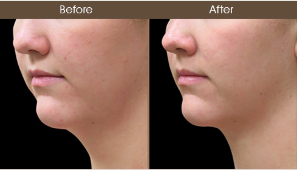 Laser Neck Lift Treatment Results